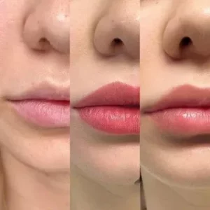 Aquarelle Lips Healing: What to Expect During Recovery
