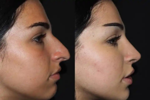 Choosing the Right Surgeon for Ethnic Rhinoplasty in Dubai