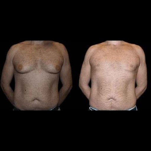 Before and After Male Breast Reduction Surgery