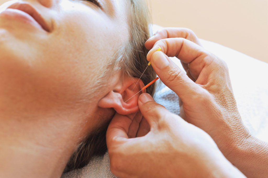 Ear Acupuncture