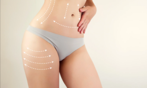 Liposuction in Dubai