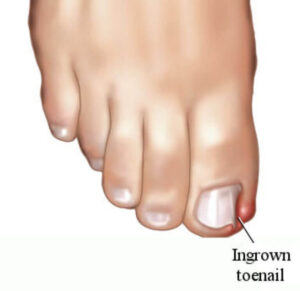 Solutions for Ingrown Toenails and Other Nail Injuries