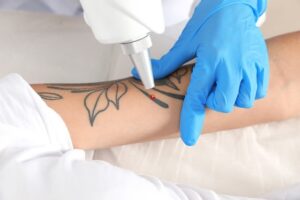 How to Minimize Pain During Laser Tattoo Removal