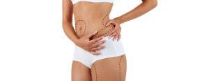 Liposuction in Islamabad