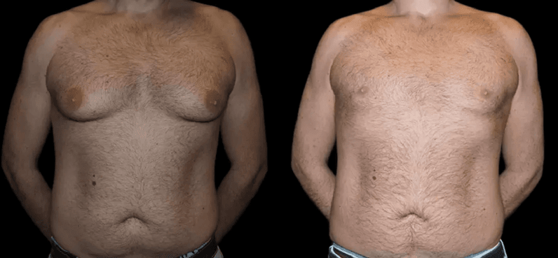 male breast reduction in Dubai