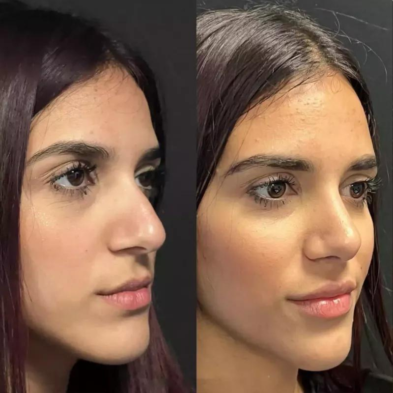 All About Rhinoplasty in Dubai: Costs, Surgeons, and More