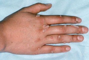 wart removal hand in Islamabad