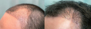 Hair Transplants Procedure in Karachi