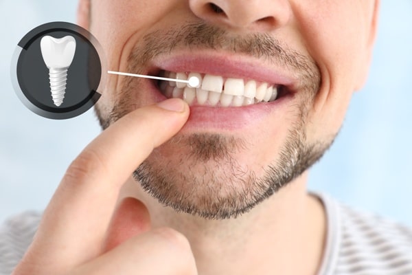 dental-implants in Islamabad