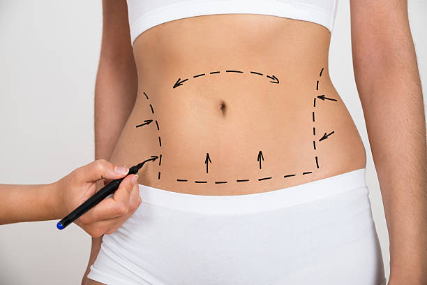 "Understanding Liposuction: A Path to a More Sculpted You"