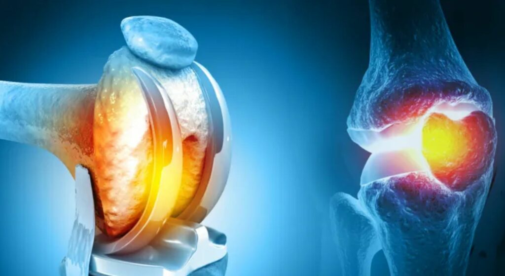 knee replacement images