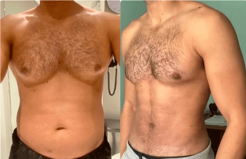 Gynecomastia Surgery in Dubai