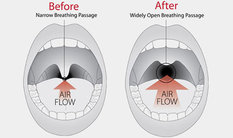 treatments for snoring