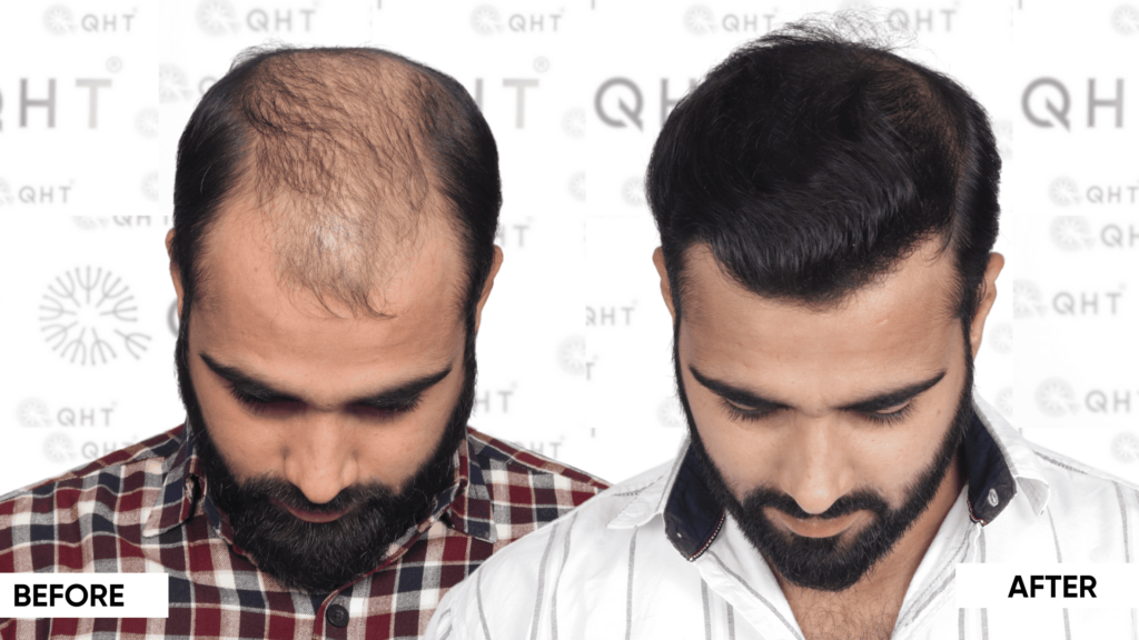 QHT hair Transplant