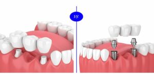 Dental Implants vs. Bridges Which One Should You Choose