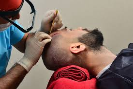 Hair Transplant in Riyadh