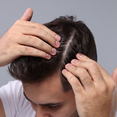 Hair Transplant in Islamabad