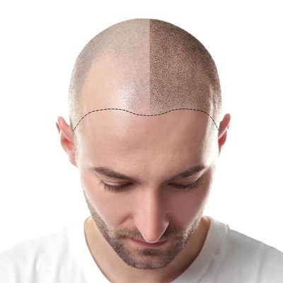 Hair Transplant in Islamabad