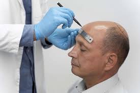 Hair Transplant in Dubai