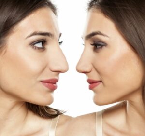 How Do I Know If I’m a Good Candidate for Rhinoplasty?