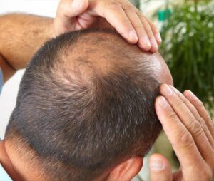 How Soon Will I See Results from a Hair Transplant?