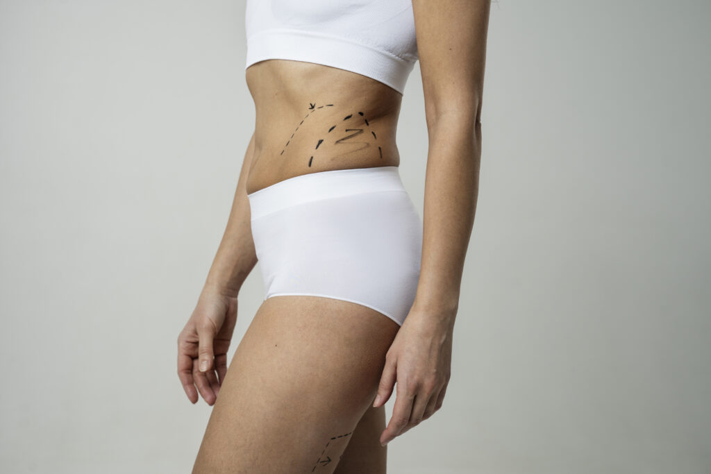 Liposuction in Dubai