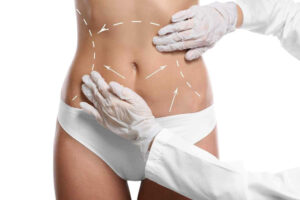 Liposuction Surgery in Dubai