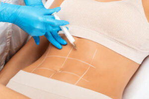 Tummy Tuck Surgery in Riyadh