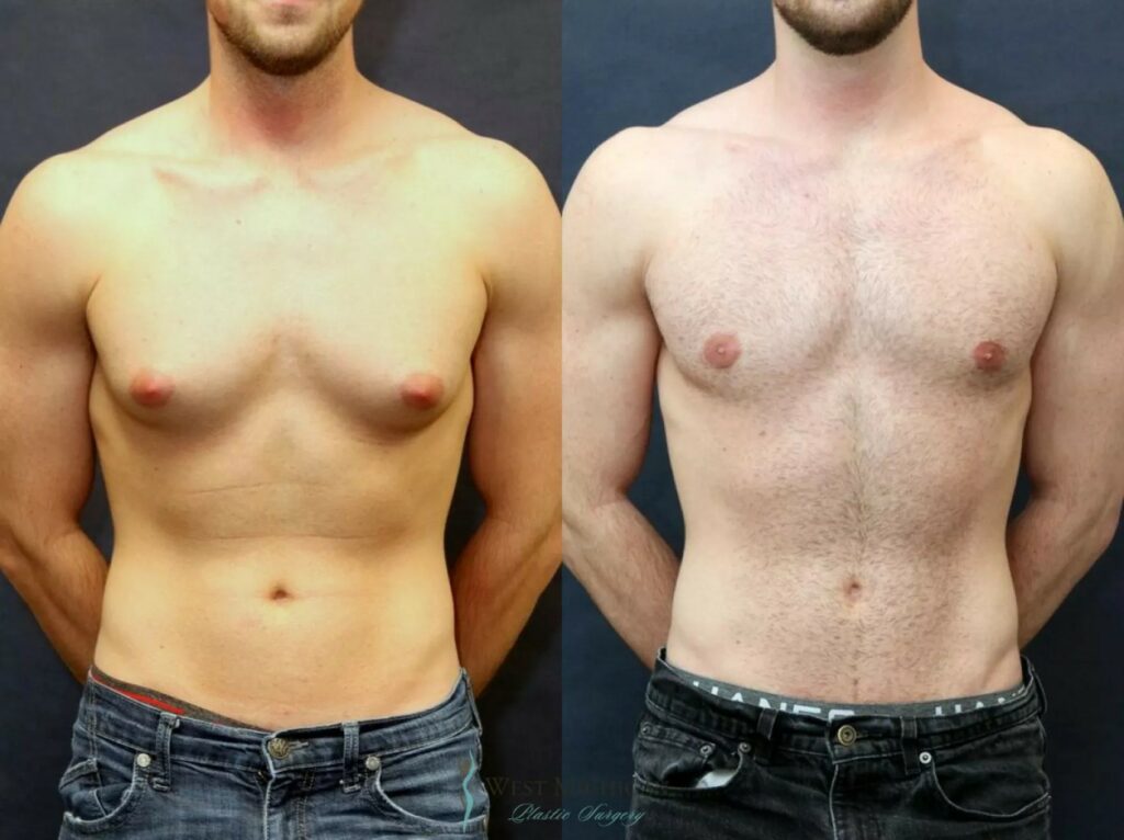 Gynecomastia in Dubai