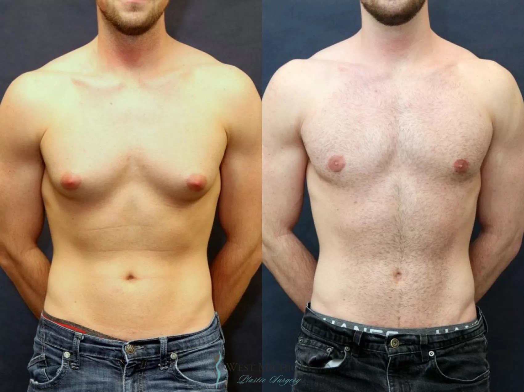 Gynecomastia in Dubai