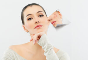 Acne Treatment in Islamabad (1)