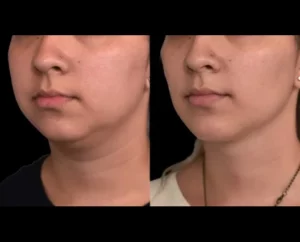 Double chin removal