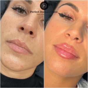 Juvederm