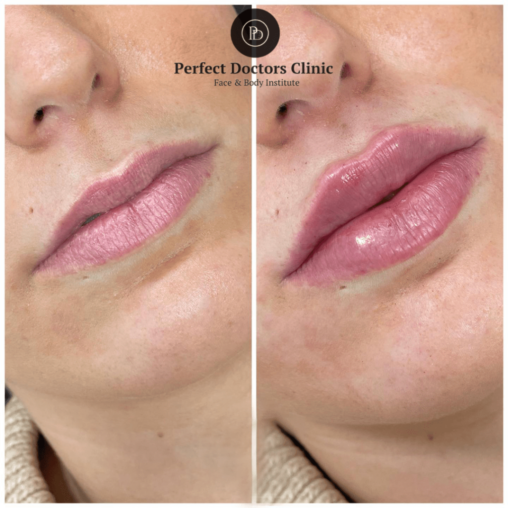 dermal fillers