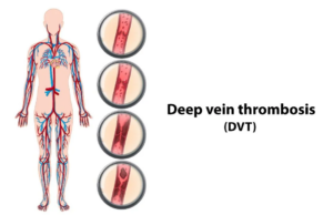 Deep Vein Thrombosis