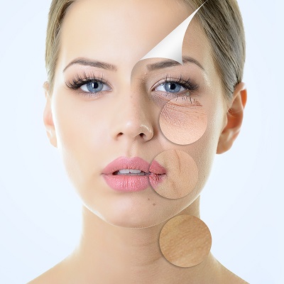 Fine Lines and Wrinkles Removal in Islamabad