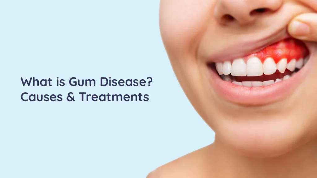 Gum Disease