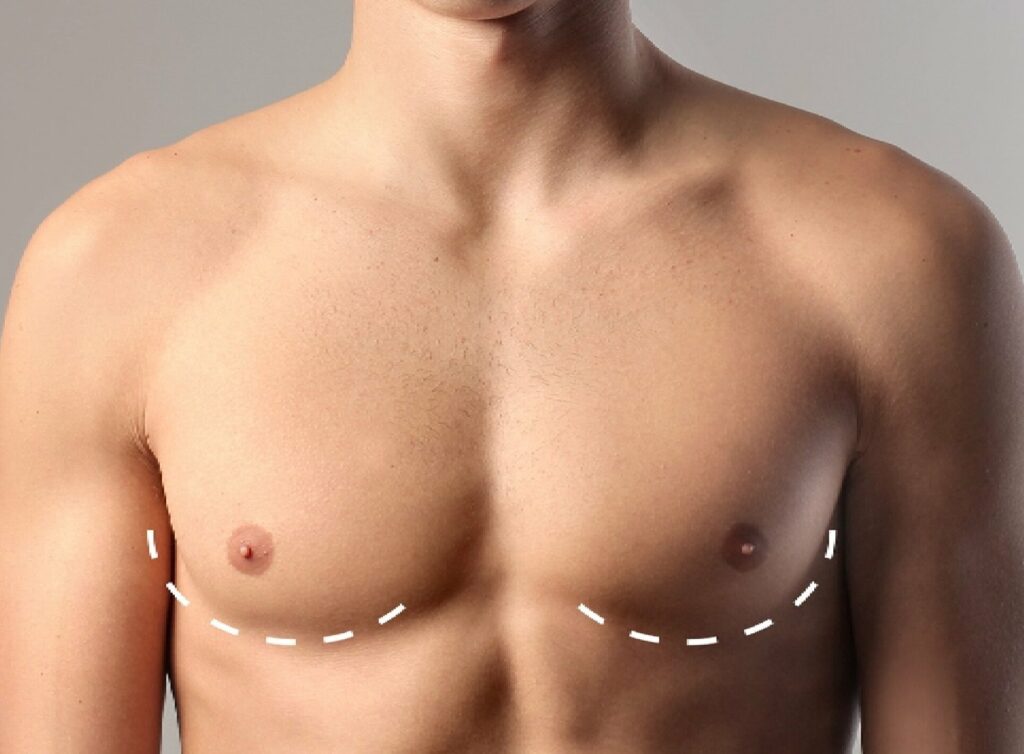 gynecomastia surgery in dubai