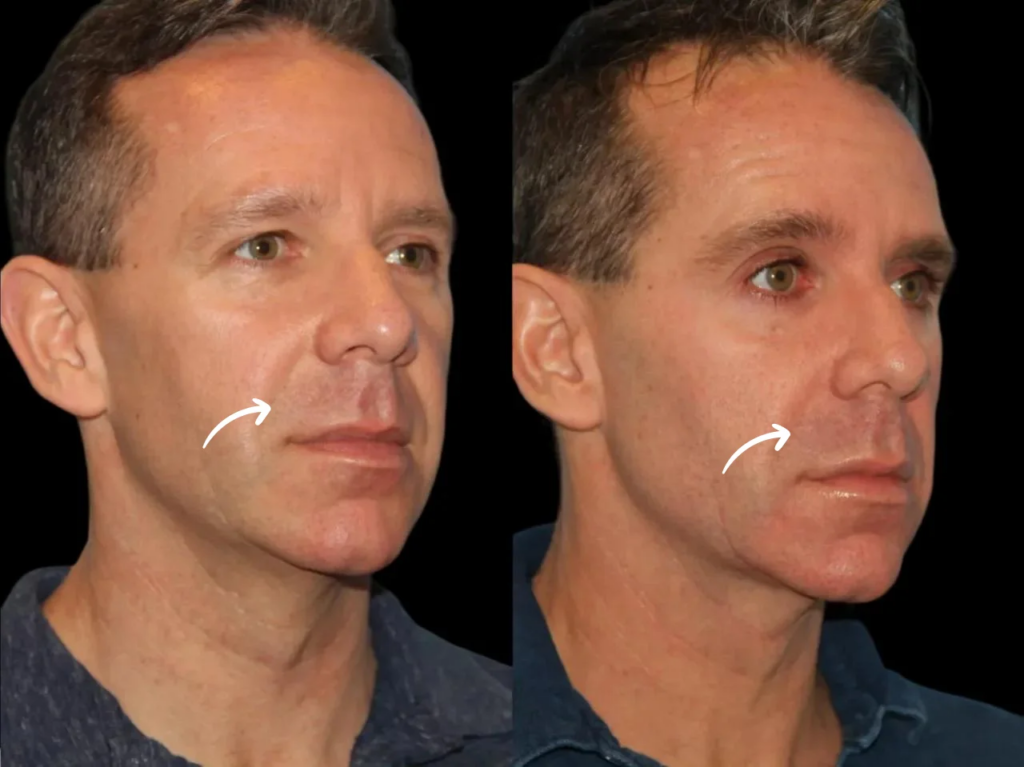 Sculptra Fillers