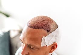 Hair Transplant in Dubai