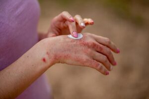 Homeopathy treatment for psoriasis