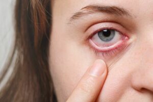 How to Prevent and Treat Eye Infections Naturally