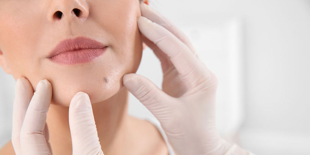 Mole Removal in Islamabad