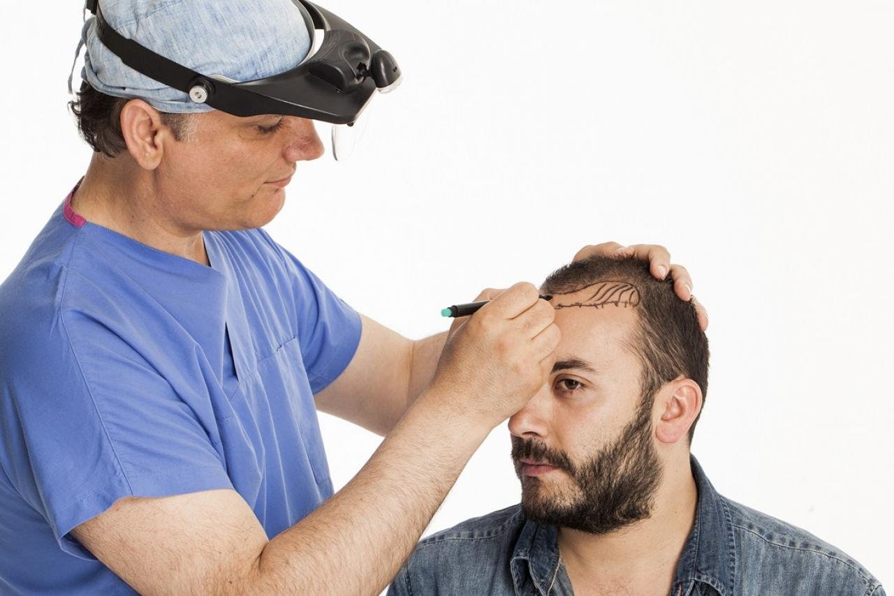 Permenent Hair Transplant in Islamabad