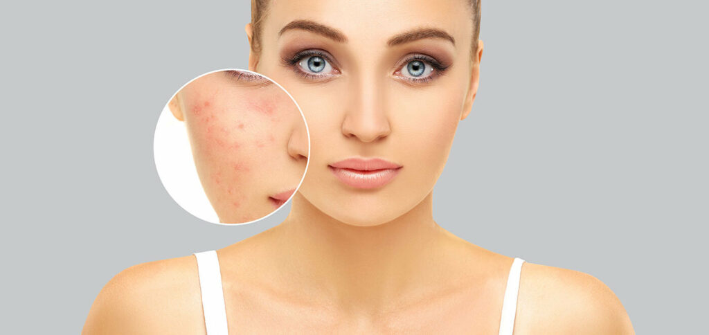 Pigmentation Treatments in Islamabad