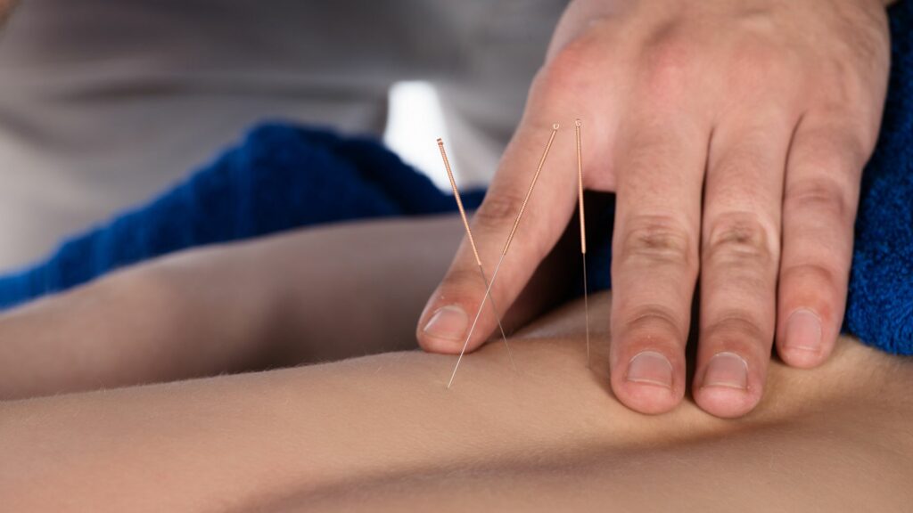 Dry Needling Therapists