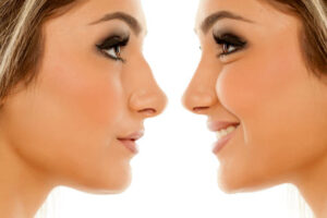 Rhinoplasty in Islamabad