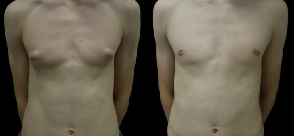 Gynecomastia in Dubai