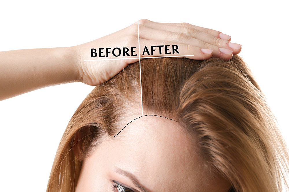 Hair loss treatment Ilford