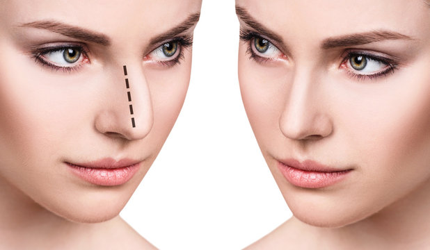 Rhinoplasty in Riyadh